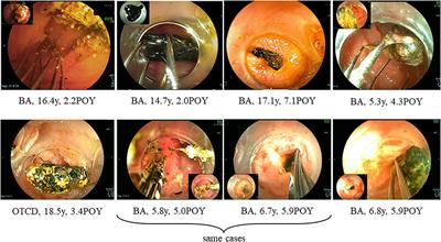 Hepatolithiasis After Living Donor Liver Transplantation in Pediatric Patients: Mechanism, Diagnosis, Treatment, and Prognosis